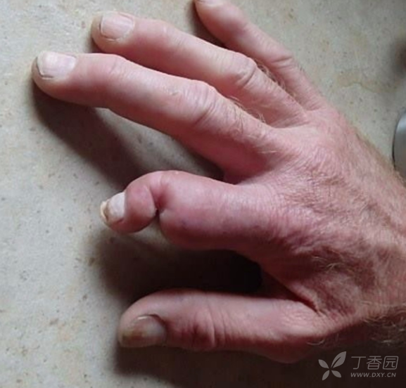 响尾蛇验伤40天后,患者没去医院打抗蛇毒血清,结果出现肌肉坏死,命大