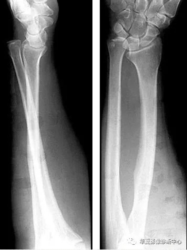 上肢5 种特殊骨折,记好分清收起来