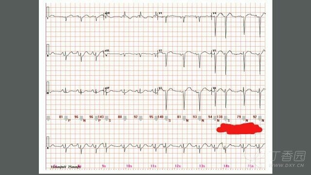 走过路过的心电图高手们,请指点迷津,这个这个心电图节律异常,请问