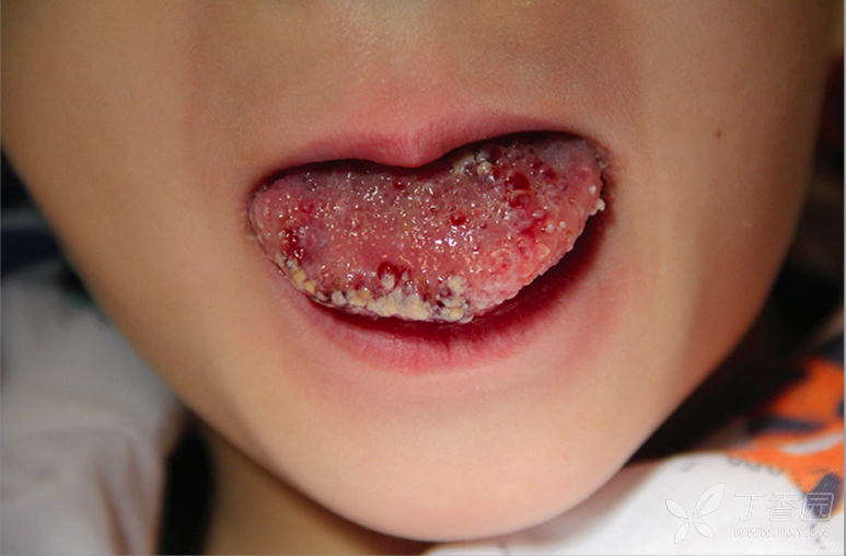 儿科专业讨论版 儿科学专区 相关疾病: 鹅口疮 淋巴管瘤 川崎病 话不