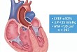 TAVR 治疗低射血分数、低跨瓣压差重度主动脉瓣狭窄患者