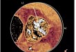 病例分享：重度钙化的带嵴二叶瓣 TAVR 一例