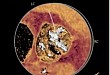 病例分享：重度钙化的带嵴二叶瓣 TAVR 一例