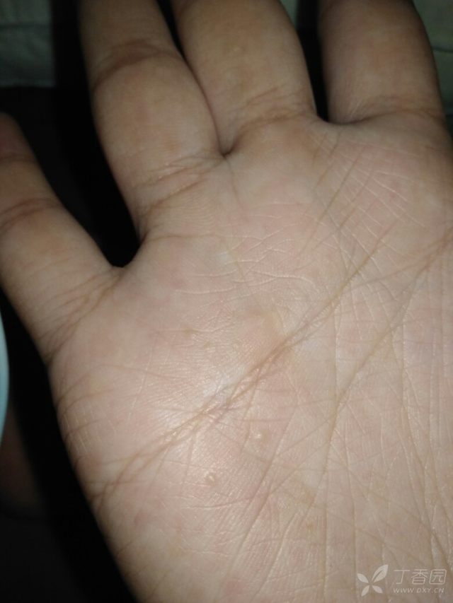 求助 手掌长了不痛不痒的硬小水泡