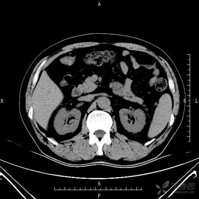 肾脏ct