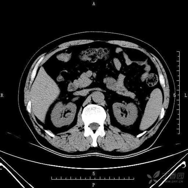 肾ct片图片