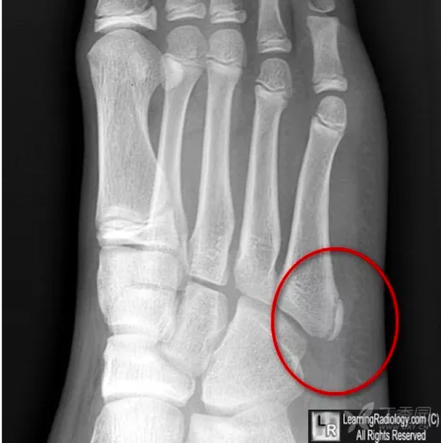 沿第五跖骨基底部长轴方向走行透亮影,骨折线多为横行