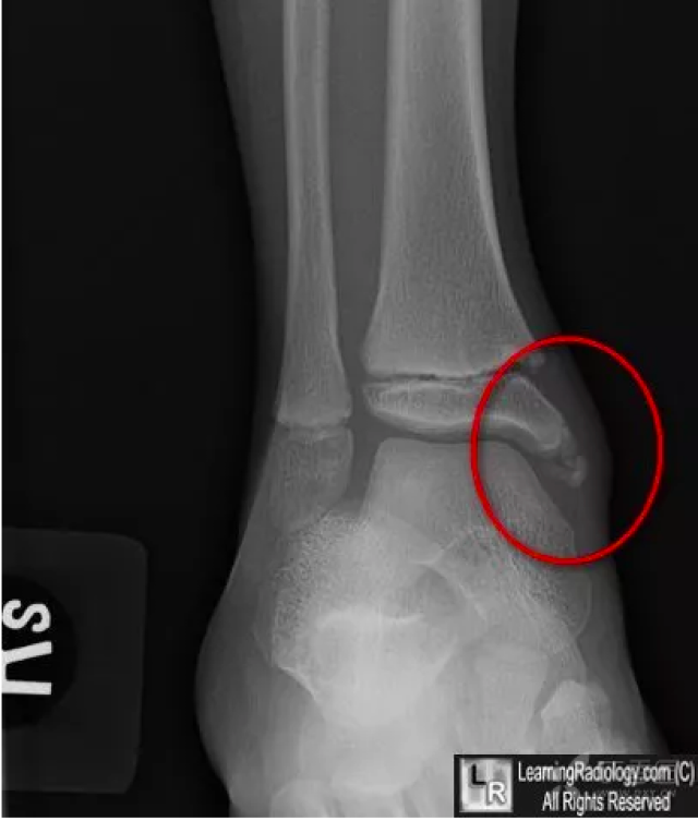 脚踝骨骺线闭合图片
