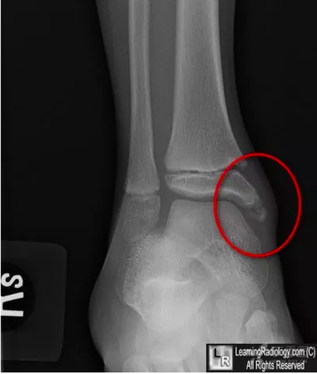 胫骨内踝的骨骺有多个骨化中心所致,见于儿童,不确定时可做双侧对比