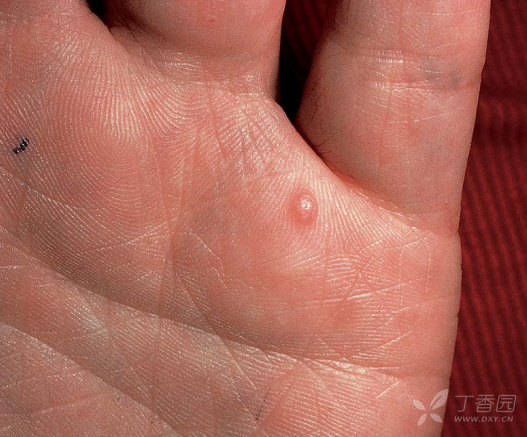 大拇指指腹有一凸起 - 皮肤与性传播疾病讨论版 -丁香园论坛