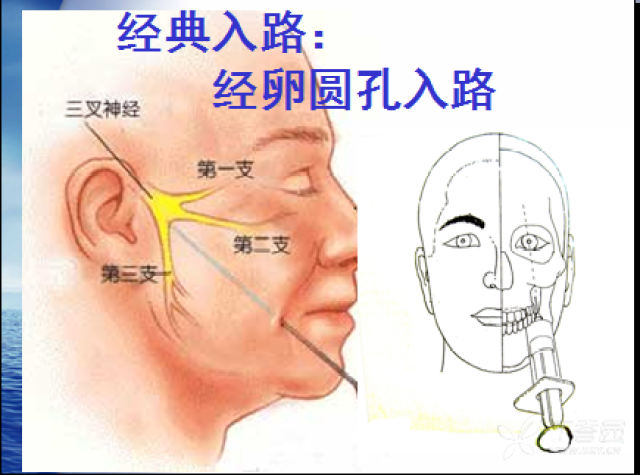 眶圆孔穿刺技术(特邀南京鼓楼医院疼痛科陶高见主任主讲)