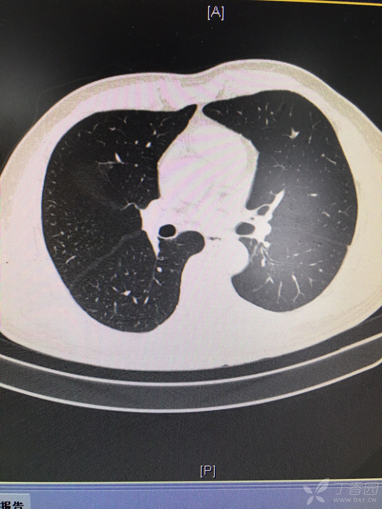 今日复查ct.支气管扩张.但患者却没有痰.误诊了.