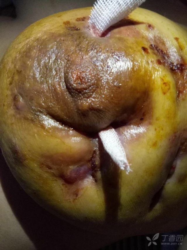 非哺乳期乳腺炎 困扰我们很久了,目前遇到一个患者预计行单乳切除,但