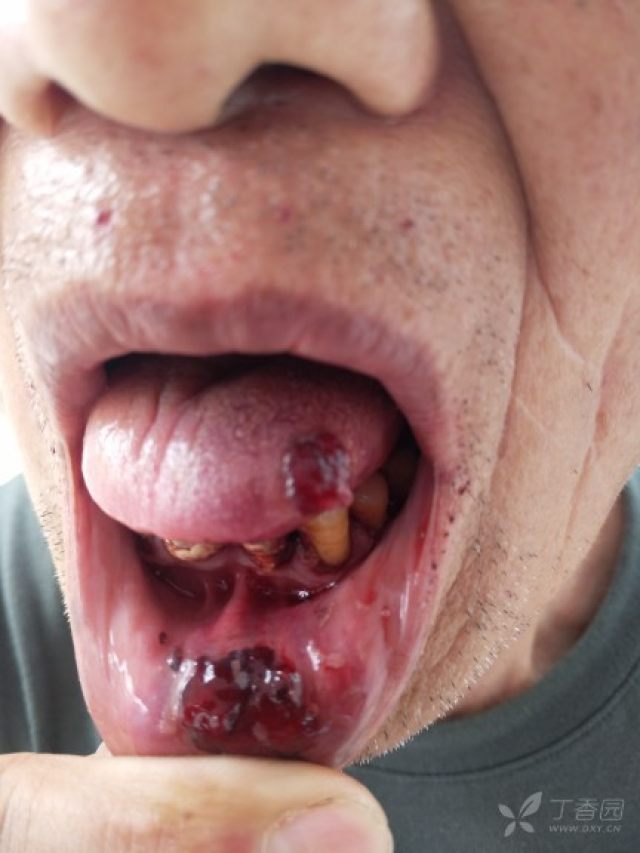 现在舌头都腐烂.