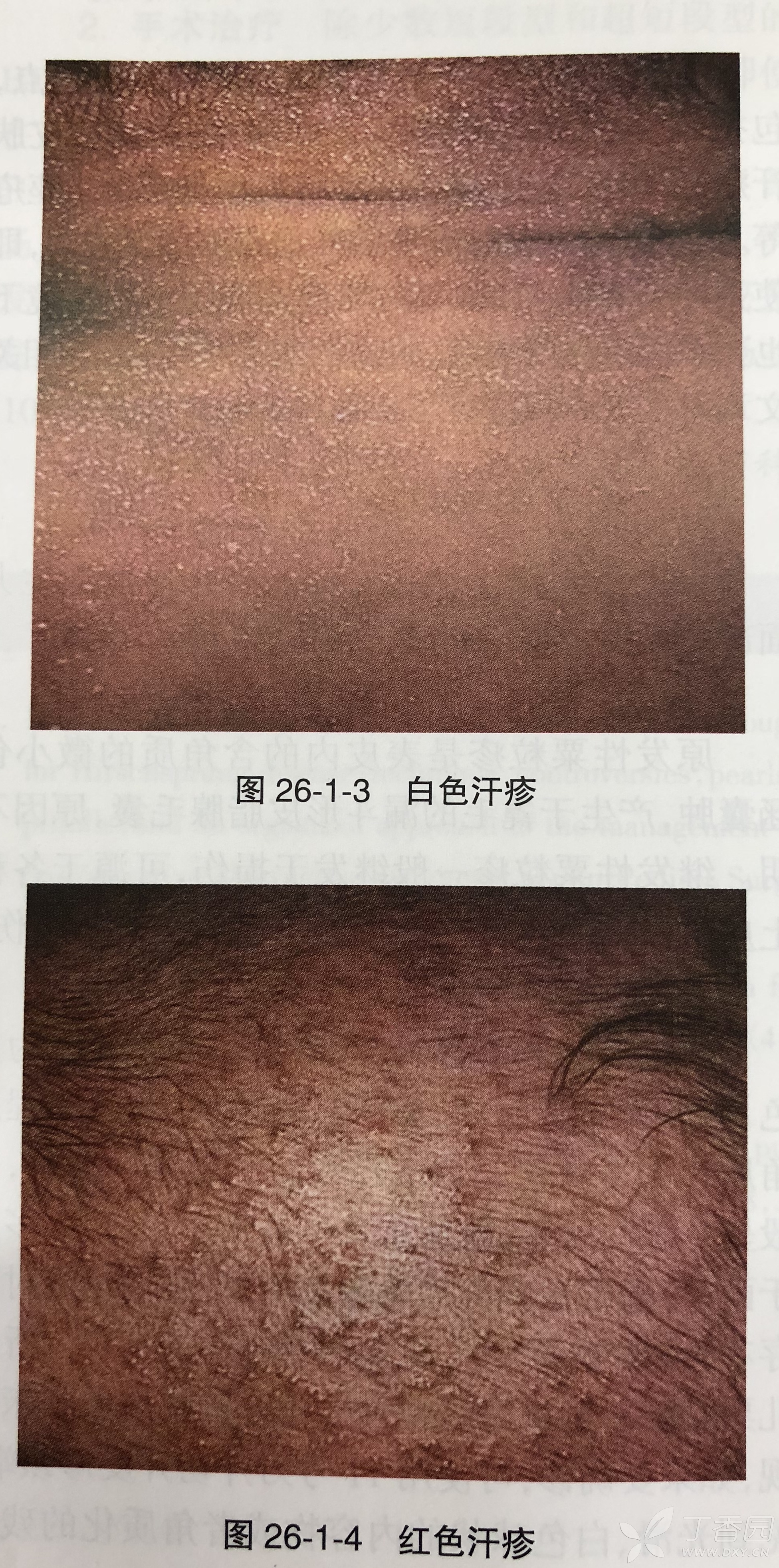 6. 汗疹