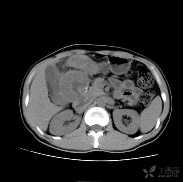 腹外斜肌锻炼方法 右上腹这个肿块，做出精准诊断真的很难！