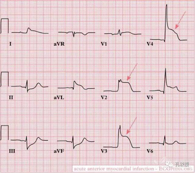 心梗心电图特点图片