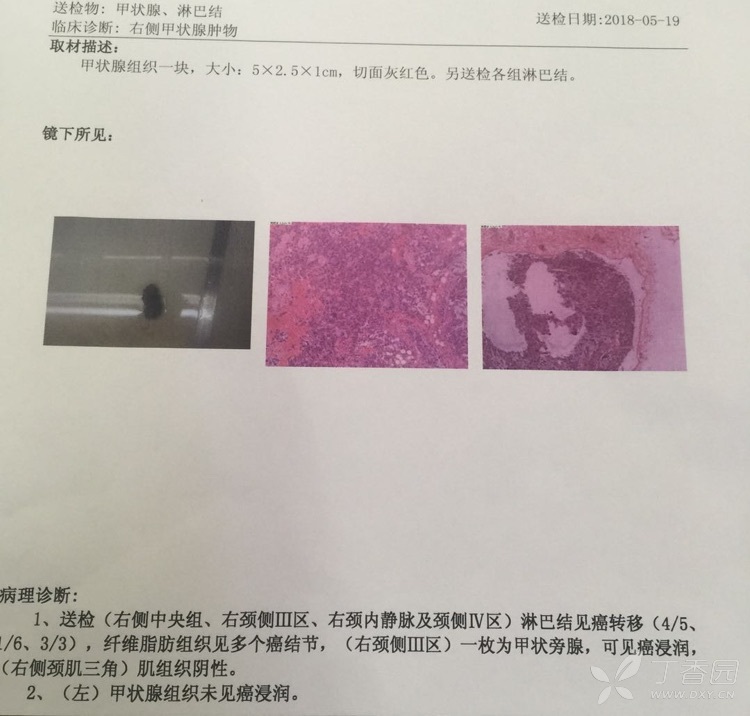甲状腺未分化癌有没有可能误诊