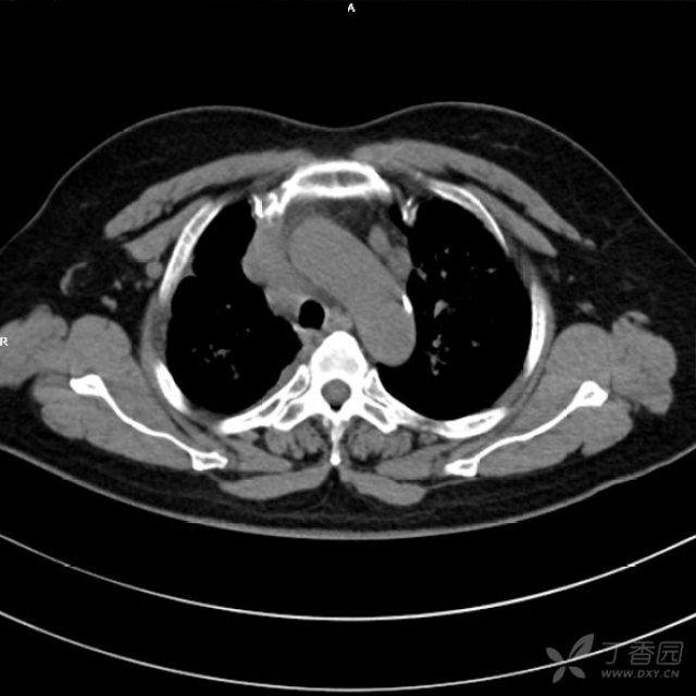 弥漫性细支气管肺泡细胞癌?
