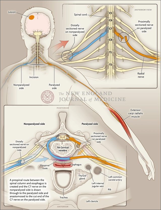 sample2--Trial of Contralateral Seventh Cervical Nerve Transfer forSpastic Arm Paralysis.png