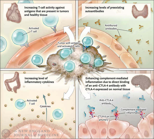 sample1-Immune-Related Adverse Events Associated with ImmuneCheckpoint Blockade.jpg