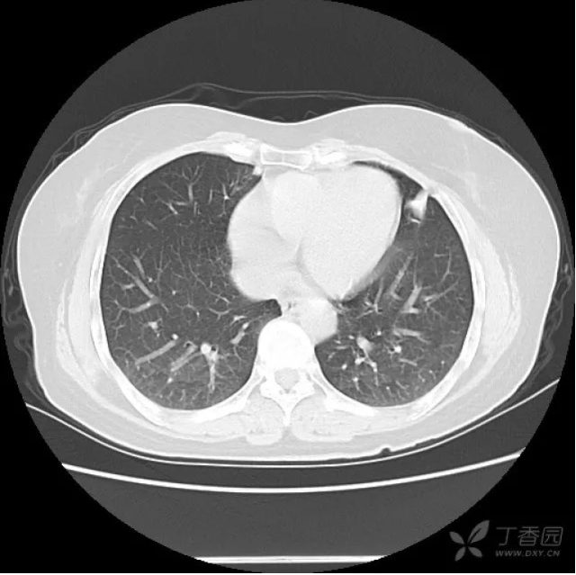 分叶毛刺ggo肺腺癌no