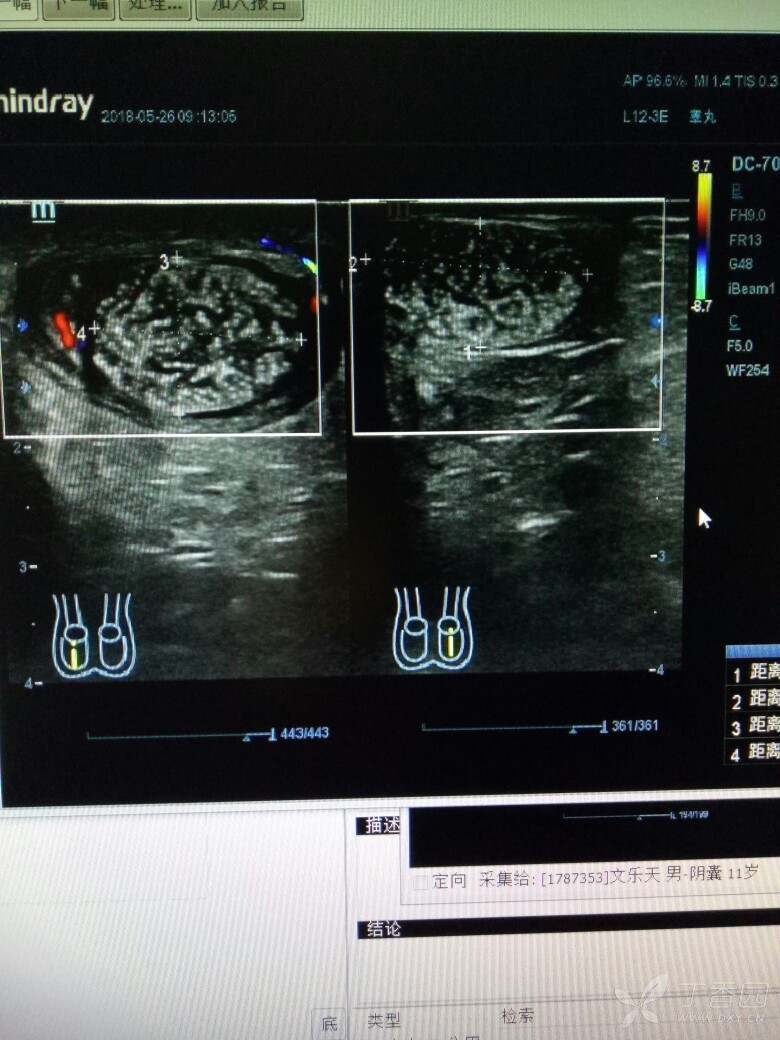 小儿睾丸回声异常