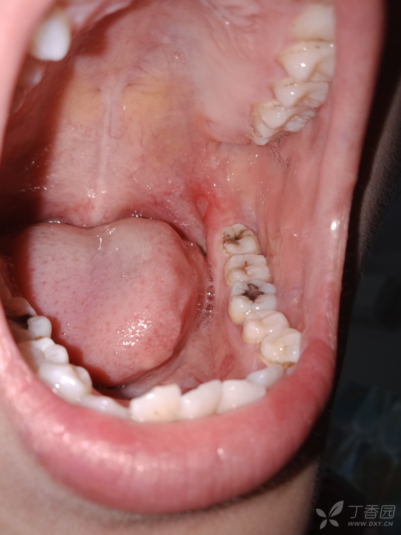口腔溃疡假膜图片