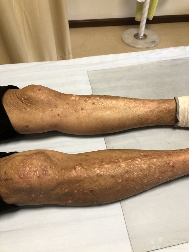 这是什么?梅毒吗?