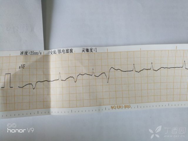 怎样看心电图报告图形 3279898041024844128-16w.jpg!w640