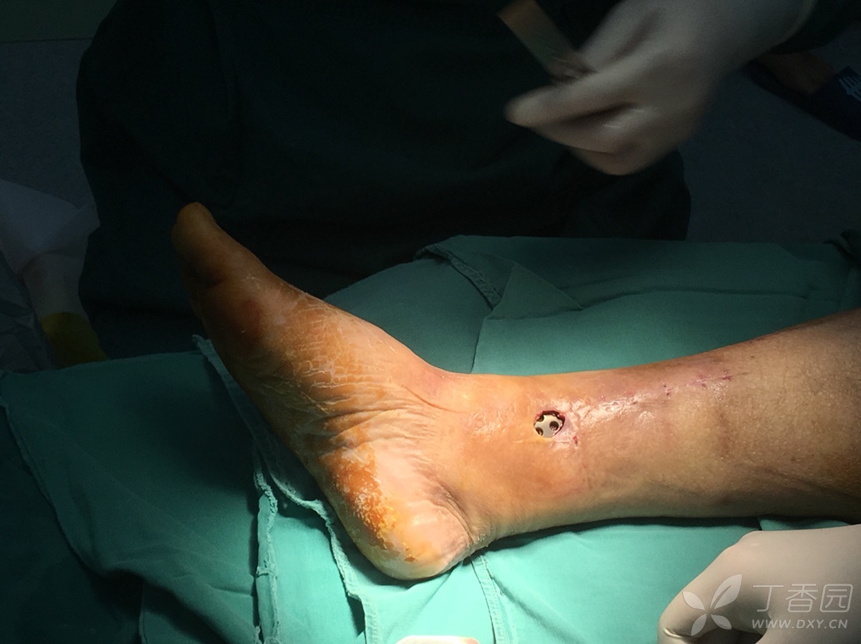 骨折内固定术后钢板外露.