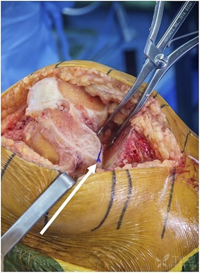 图3-1:x片示膝关节后方有较严重骨赘