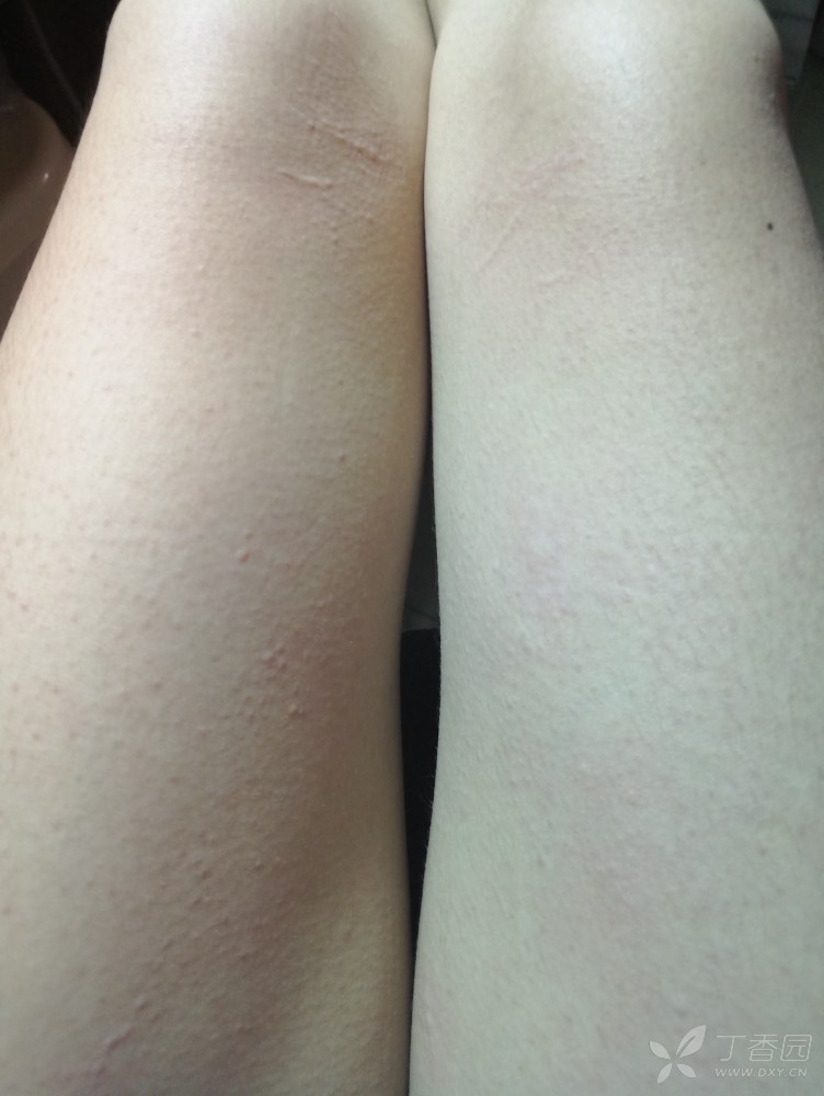 平时也是一受机械刺激就红肿,一会儿就消退不留痕迹,这是什么情况?