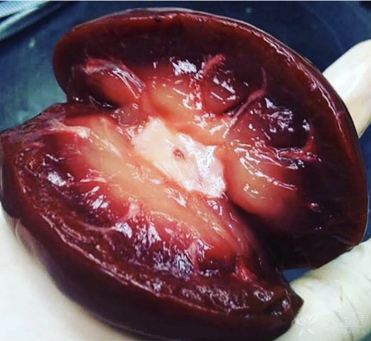 正常肾vs多囊肾,劈开看惊呆了