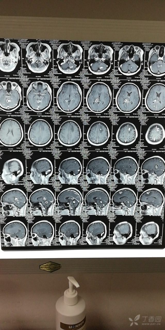 重症结核性脑炎,请大家们指导!急!