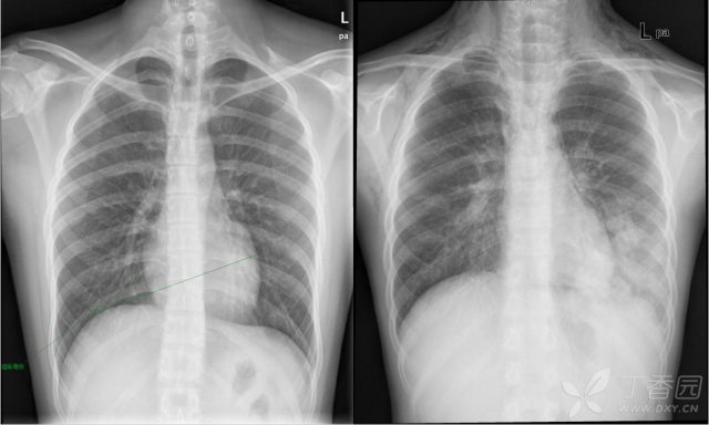 左:正常胸片,有边际效应;右:纵隔气肿患者胸片