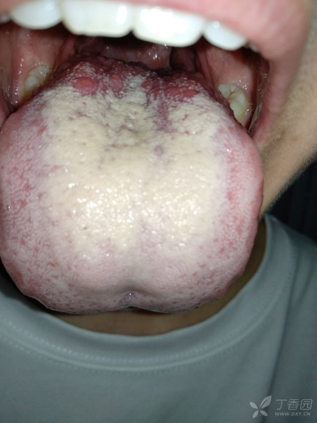 相关疾病: 尖锐湿疣 疣 下体感染了尖锐湿疣,长出来疣体了,最近口腔不