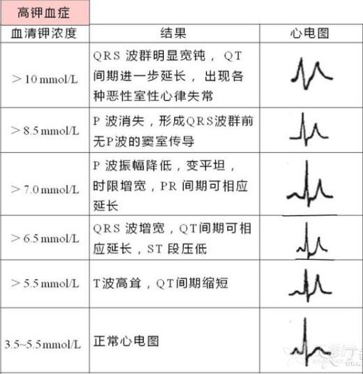 30):高钾血症的心电图表现有?