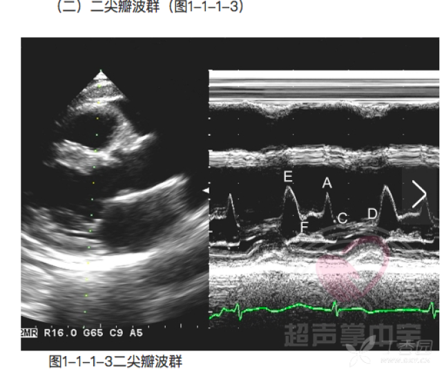 初始心超学习总结(一)——胸骨旁左室长轴切面