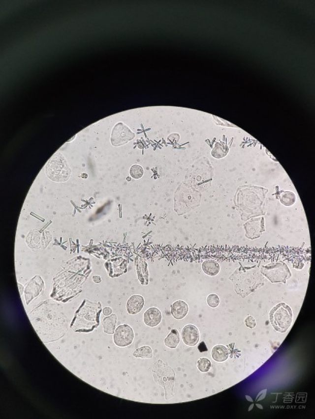 尿液里面的, 干化学维c3 ,蛋白1 ,镜下大量小圆上皮细胞.