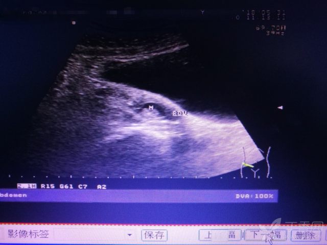 什么是混合性结节 3281024411230638494-16w.jpg!w640