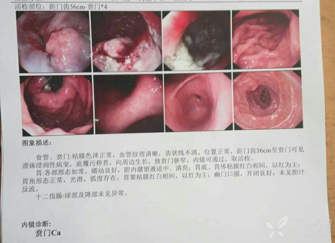 贲门胃镜照片图片