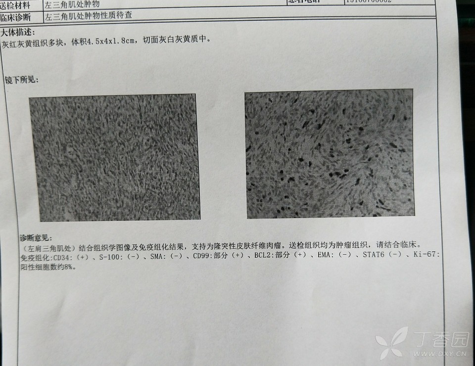 隆突性皮肤纤维肉瘤 [病例帖]