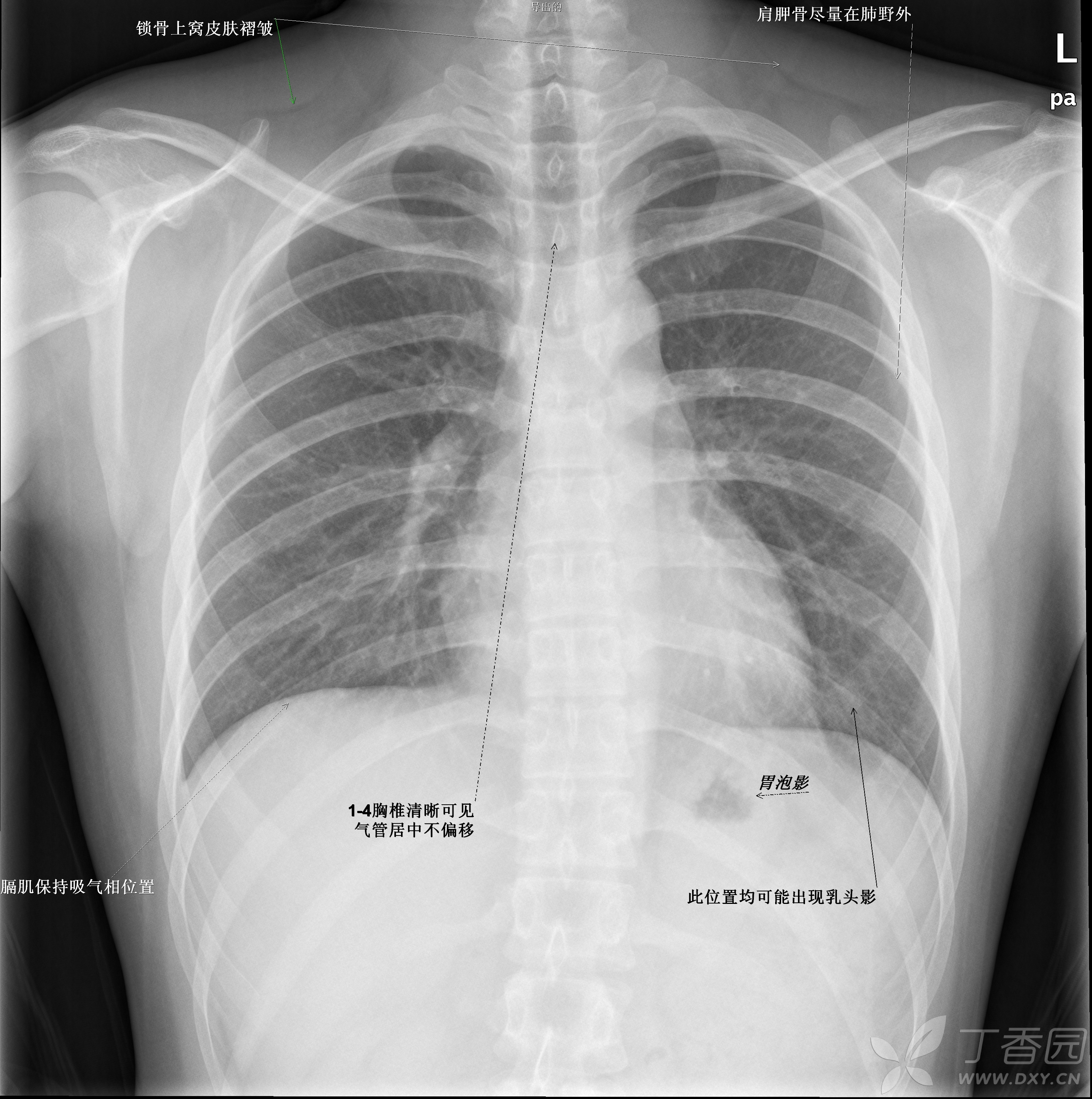 图2-186 胸廓及肺尖(前面观)-骨科临床解剖学-医学