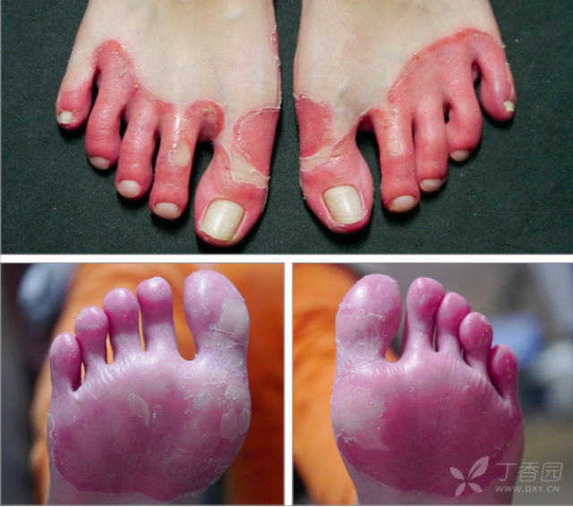 儿科专业讨论版 儿科学专区 相关疾病: 川崎病 接触性皮炎 皮炎 话不