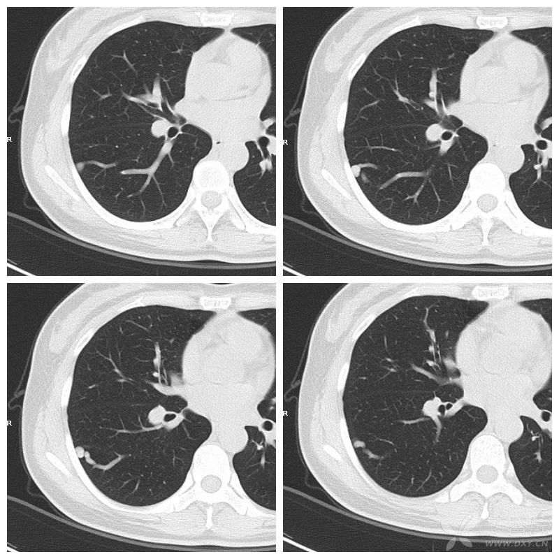 3,右肺上叶后段动静脉畸形