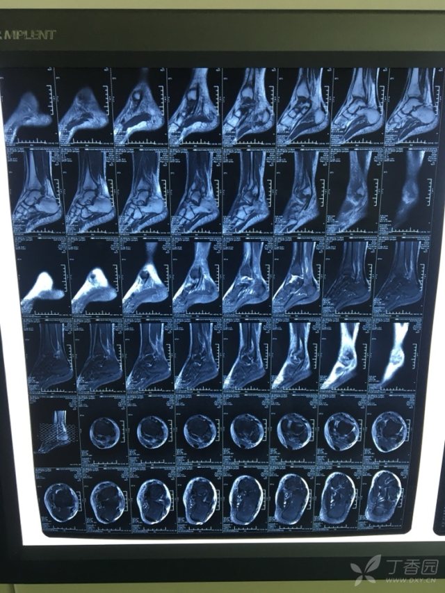 疑问:如果下胫腓联合与三角韧带同时损伤,是单纯固定下胫腓即可还是