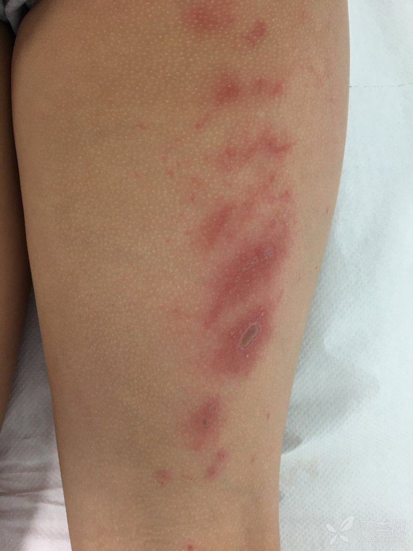 是否为虫咬性皮炎？ - 儿科专业讨论版-丁香园论坛