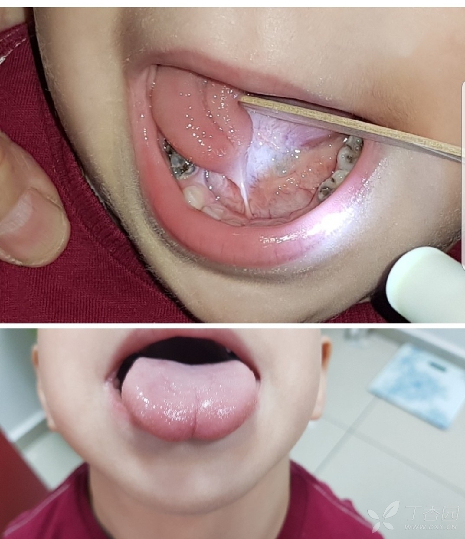 小孩舌头裂开的图片图片