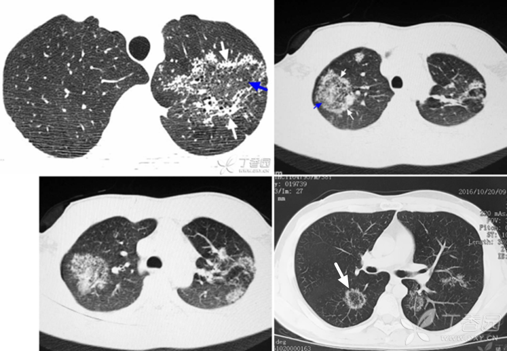 另外两例:反晕征---肺结核.